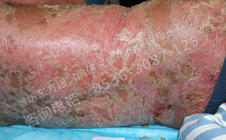 牛皮癣患者能不能使用化妆品呢？
