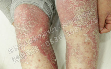 春季来临银屑病患者如何养生
