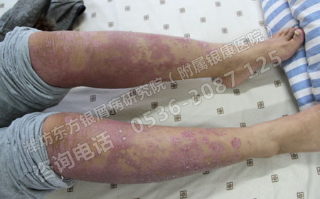 女性患上银屑病该怎么办呢？