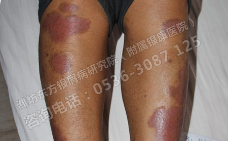 牛皮癣患者在什么时候治疗可以得快