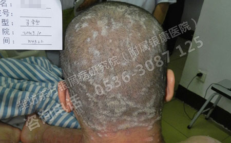 如何预防儿童银屑病的发生呢？