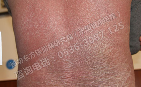 红皮型牛皮癣的危害有哪些