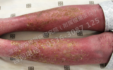 为什么患有牛皮癣的人越来越多