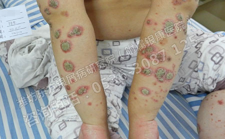 激素类药物治疗银屑病有什么危害
