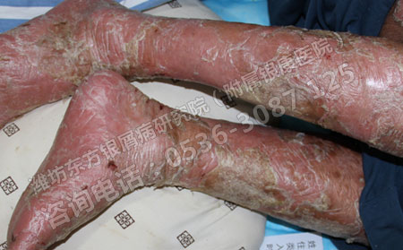 济南女性银屑病患者怎么进行护理