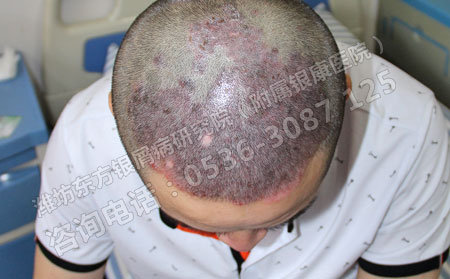 诱发儿童银屑病的因素有哪些