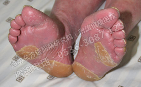 导致银屑病越治越严重的原因有哪些