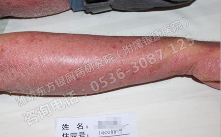 关于银屑病患者春季保健问题的总结