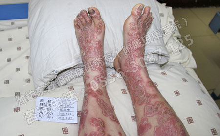 银屑病患者如何确诊自己的病情