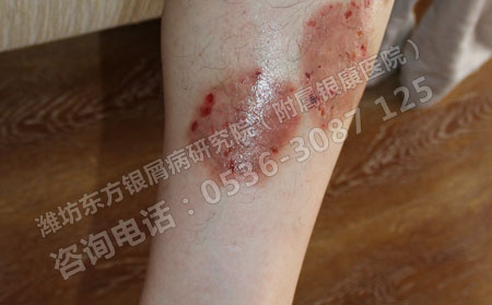 孕妇治疗银屑病用药应该注意什么