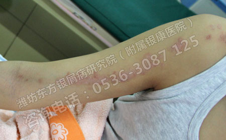 银屑病发病初期会有什么样的症状表现