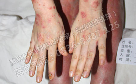 天气转暖女性银屑病患者如何保持正常肌肤