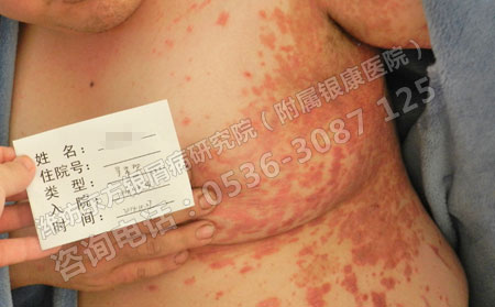 济南银屑病医院解读老年银屑病的类型
