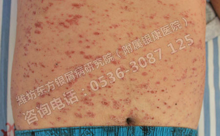 寻常型银屑病治可以后可以避免复发吗