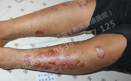 济南银屑病患者应该选择什么样的医院治疗