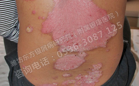 背部出现小面积银屑病需要治疗吗