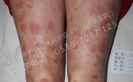 银屑病预防需要做可以以下方面