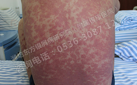 济南牛皮癣医院需要做哪些检查