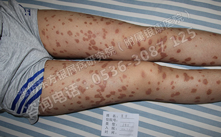 预防银屑病要注意几个方面