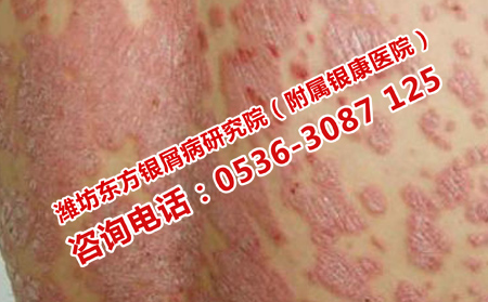 夏季背部牛皮癣科学护理的方法是