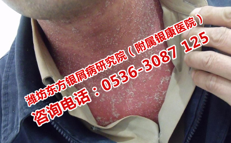 头部银屑病有哪些外用药物
