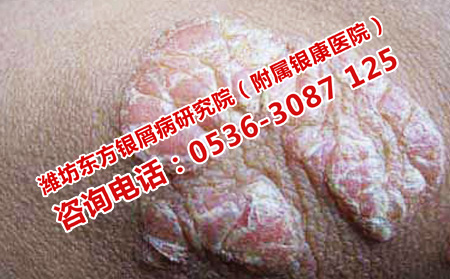 脓疱型牛皮癣临床治疗的关键是什么