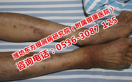 得了脓疱型牛皮癣怎么治疗呢