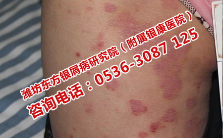 气温异常银屑病患者如何做可以日常护理
