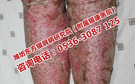 为什么会得脓疱型牛皮癣