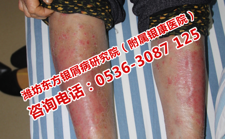 红皮型牛皮癣怎样治疗较有效