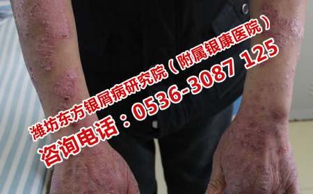 为什么用中医治疗牛皮癣呢