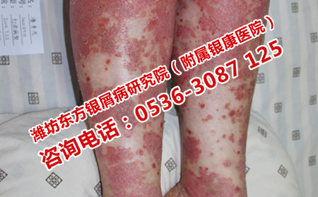 得了牛皮癣怎样治疗较有效