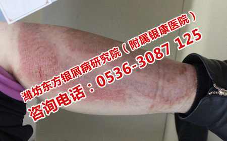 牛皮癣患者在日常应该如何护理