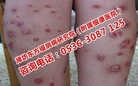 济南治银屑病可以的医生