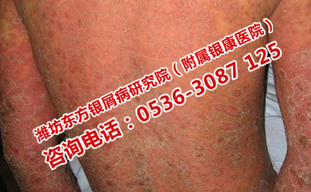 如何选择治疗牛皮癣的医院呢