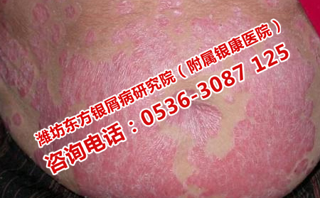 牛皮癣前期的特别症状