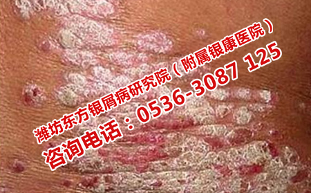 如何使早期牛皮癣恢复效果可以