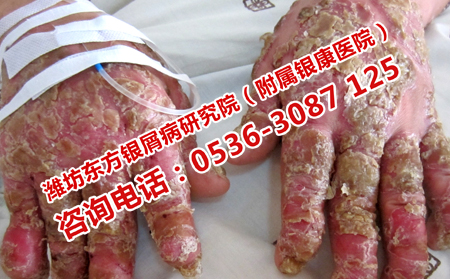 淄川治牛皮癣可以的医生