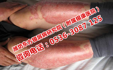 济南专门牛皮癣医院