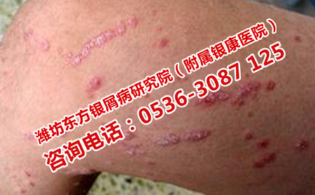 银屑病不恢复的原因