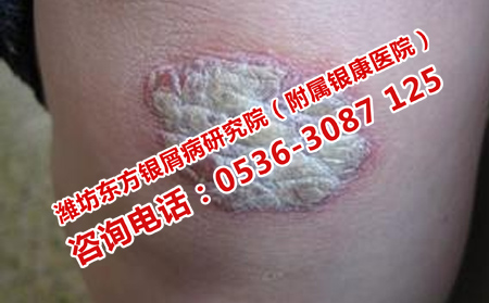 如何进行银屑病治疗