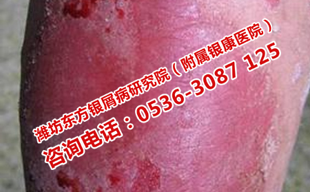 暖气房内的牛皮癣护理