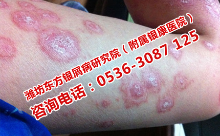 哪里治疗银屑病可以