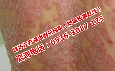 济南银屑病治疗
