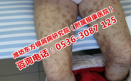 治银屑病很可以的方法