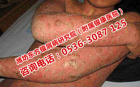 济南中医治疗银屑病