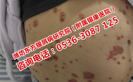 背部银屑病的护理