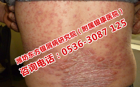 治疗银屑病公立医院