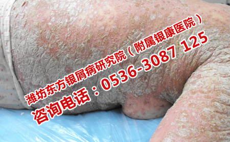 济南银屑病医院如何预约