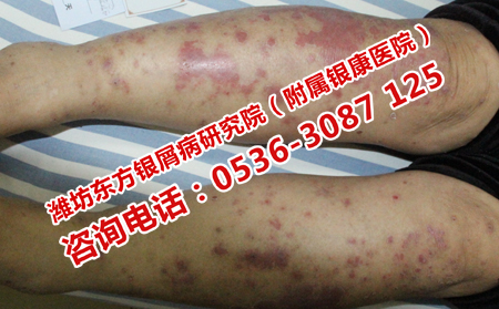 银屑病患者可以吃保健品吗